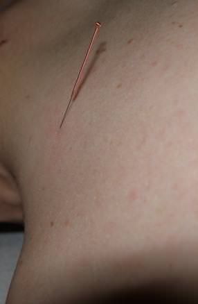 Commonly used acupuncture point