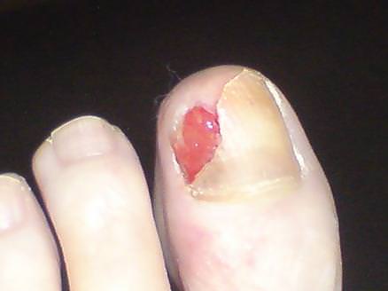 Severe ingrown toenail